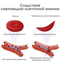 Серповидноклеточная анемия Серповидноклеточная анемия.